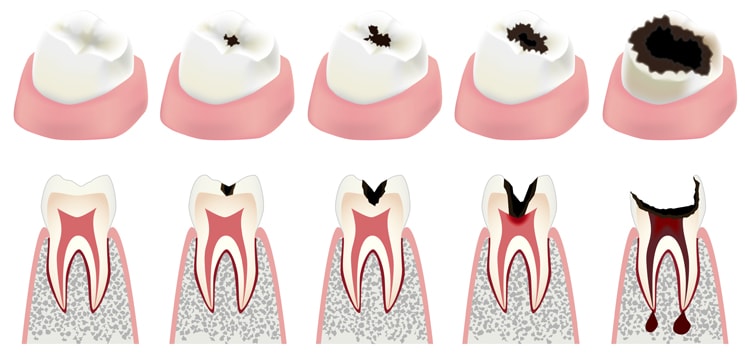 虫歯の進行度による分類