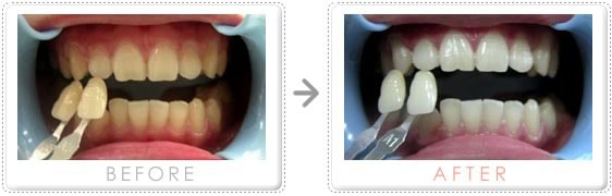 ホワイトニングの施術例