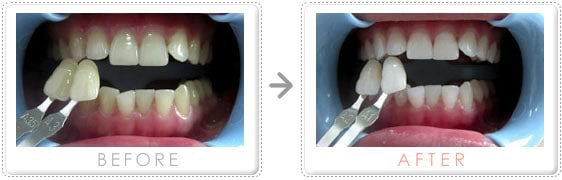 ホワイトニングの施術例